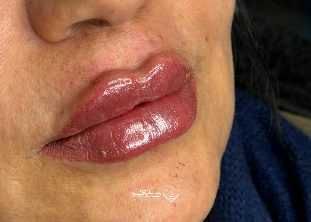 lipfillergallery-03