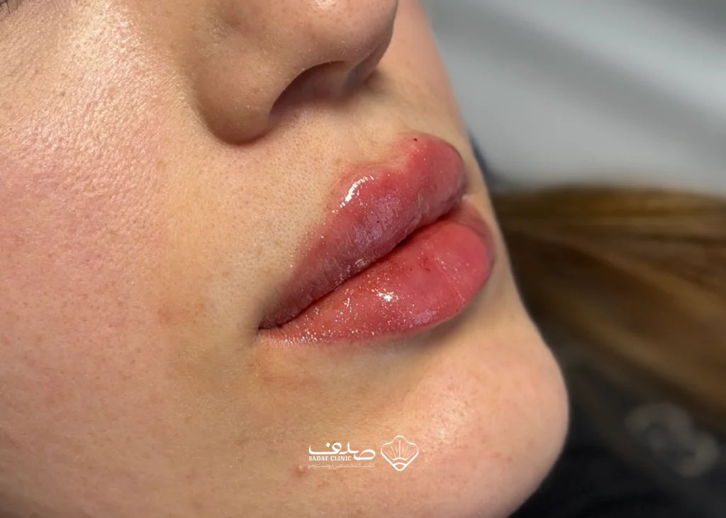 lipfillergallery04-03