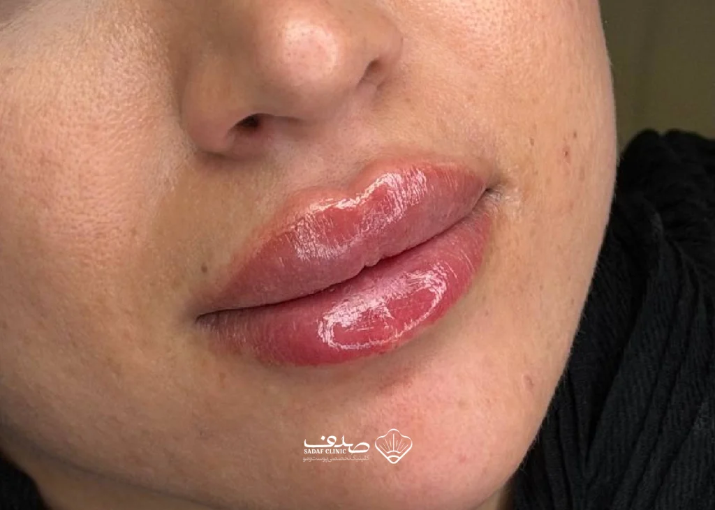 lipfillergallery05-03