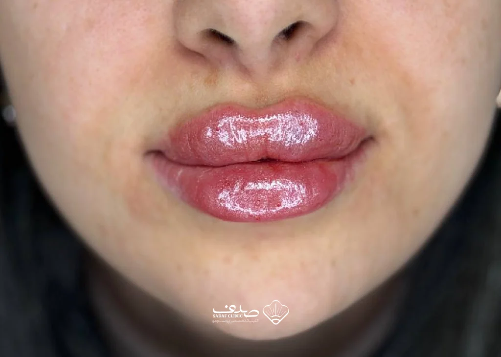 lipfillergallery07-03